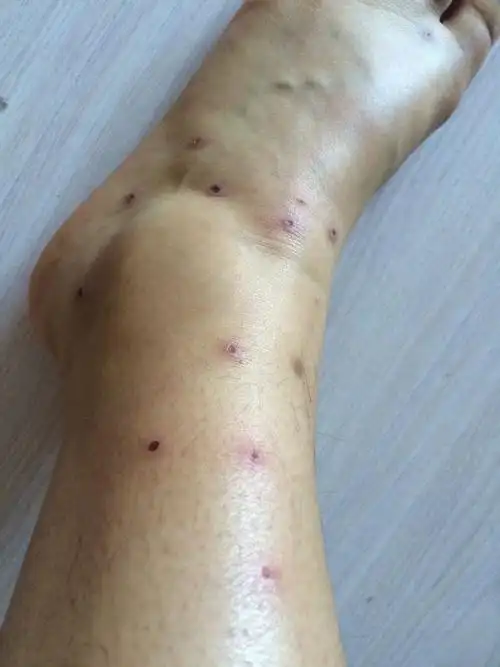 被跳蚤咬了,满腿的包,抓破了还是很痒,去皮肤诊所看了,开的中药粉和