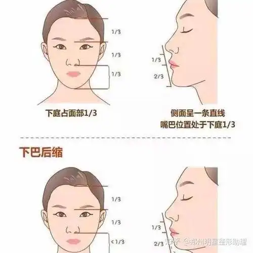 在口腔内做切口,分离骨膜,将经过雕刻的假体植入下颌部位,然后精细