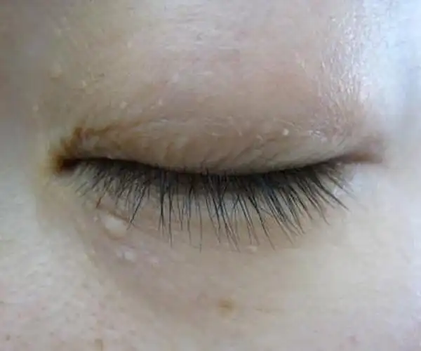 手臂脂肪粒图片