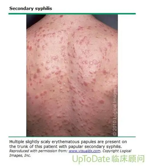 梅毒面面观