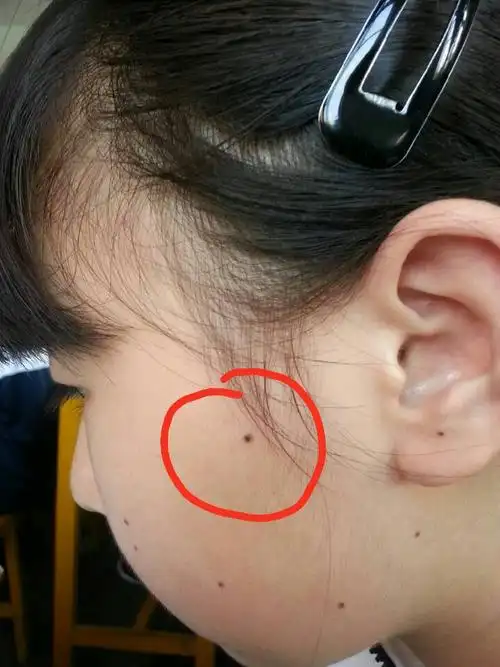 那颗痣刚刚昨天点,现在不会是黑色素扩散吧?懂的点过得回答