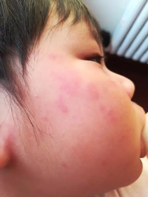 孩子身上有红斑,吃过蚕蛹和猕猴桃,请指教
