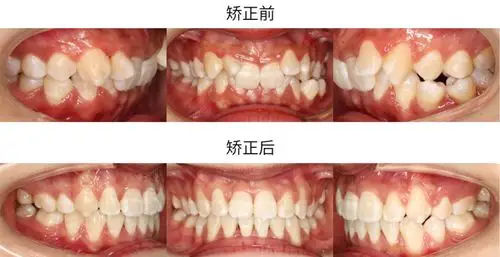矫正前后口内像对比