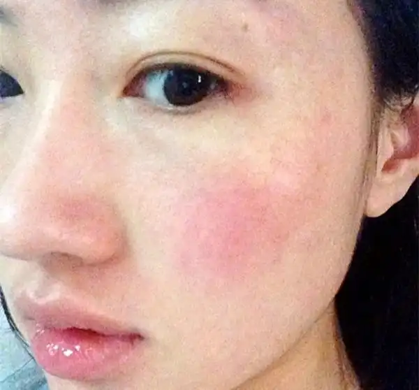 敏感皮肤经常泛红长痘,在选择洁面产品的时候要谨慎
