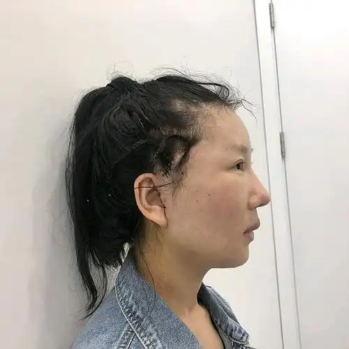 小切口拉皮 人中缩短【术后1周】