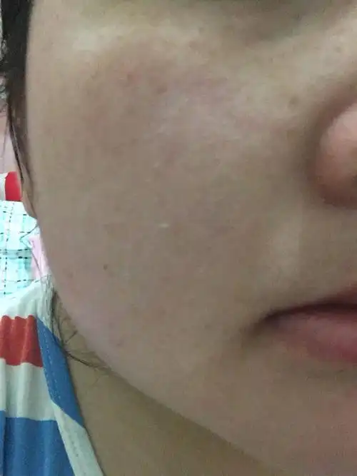 问:洗脸后皮肤紧绷,起皮,很干,而且还会痒,很难受 如果摸了水和乳液