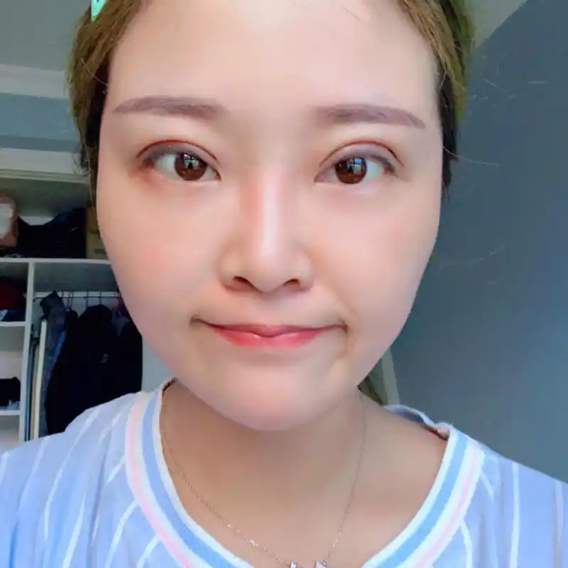 平行双眼皮第七天