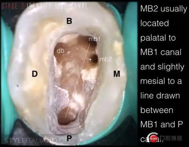 上颌mb2真的存在吗676767