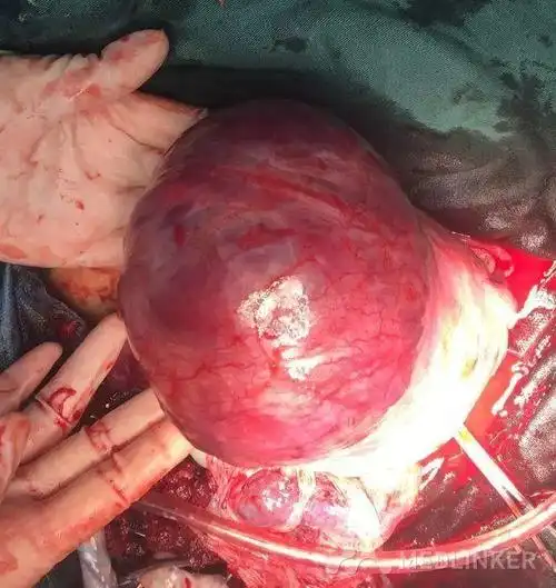 宫角妊娠孕足月胎盘植入疤痕子宫