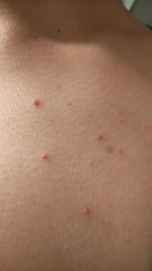 请问胸口长很多这个痘痘是怎么回事?用什么药好