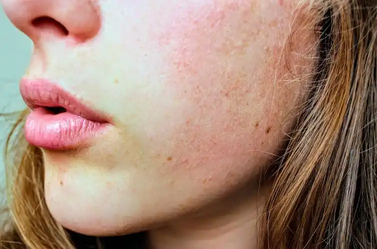 白色口罩反射紫外线,易引起皮肤问题!