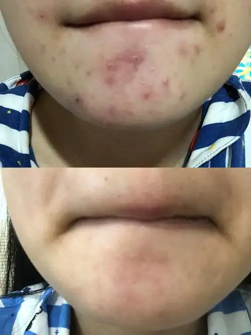 皮肤屏障受损修复交流专用楼