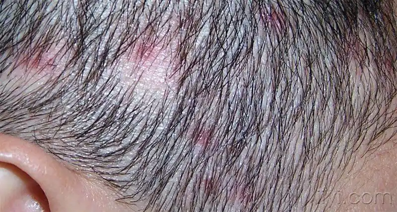 毛囊炎吃什么药