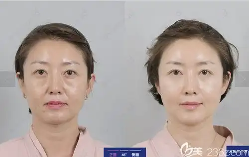 韩国原辰面部提升真人案例前后效果对比图