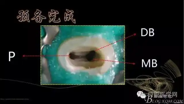 上颌第一前磨牙3根管