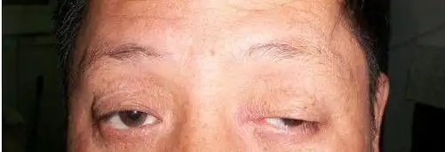 3位国医大师治疗重肌无力经验6方,含方剂,推拿,贴敷,以及18种附症