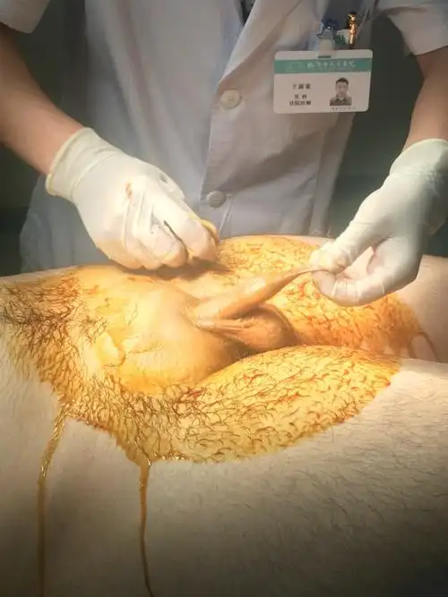 实图一一包皮环切1