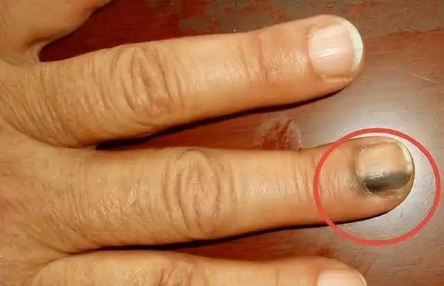 为何癌症和指甲有关系?