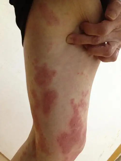 早期梅毒感染症状图图片