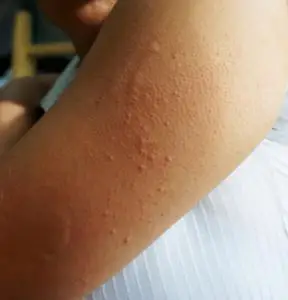 手臂皮肤过敏性皮疹皮炎照片