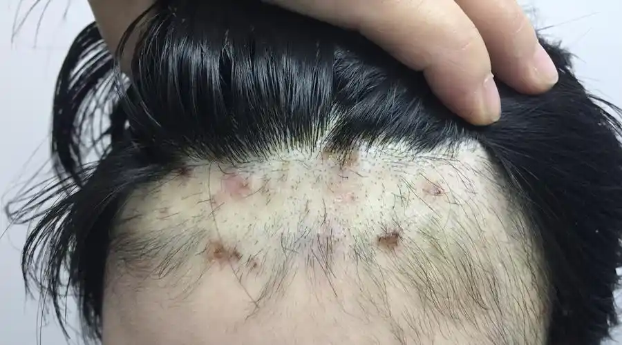 一做作业就拔自己头发? 小学生患上"拔毛癖"险"秃顶"