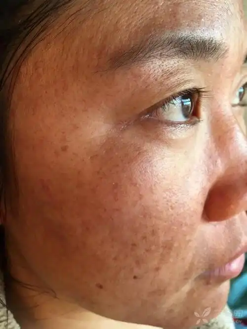 各位同仁,黄褐斑如何正规治疗,方法求教 - 皮肤与性传播疾病讨论版