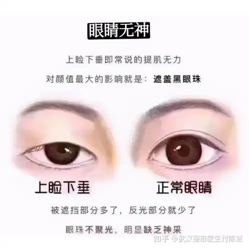 什么是上睑下垂