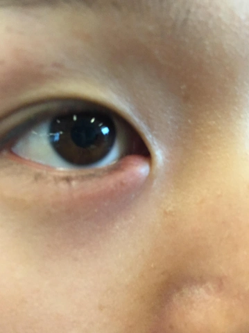 眼角长了个疙瘩图片 (16)_有来医生
