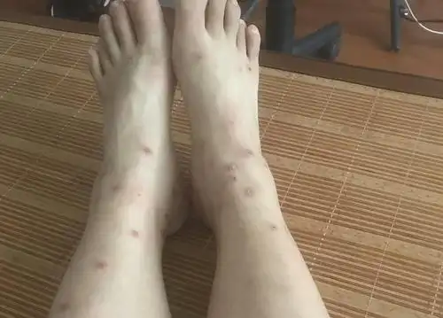 渗入如何判断荨麻疹还是湿疹