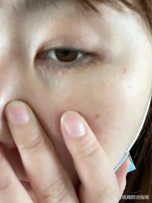 眼周围长满小颗粒 最近眼角的颗粒越长越多,也不知道这到底是什么,想