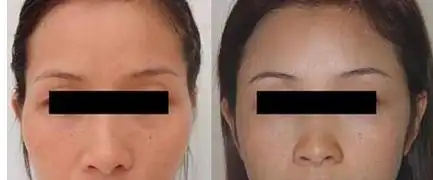 立波可自体脂肪填充前后的效果对比图