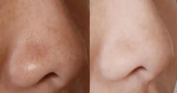 毛孔粗大|临沂瑞丽医学美容医院