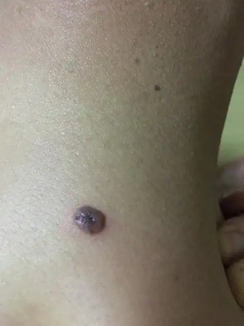 原先这个痣上有毛发…我嫌麻烦剪头发的时候就叫人给剃了…接着这个痣