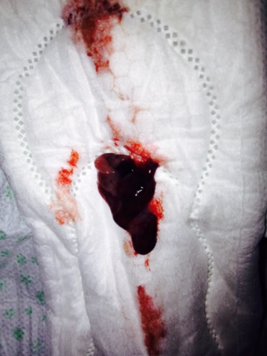 我药流了,怎么第11天他还流血了不多本来前几天都干净了怎么啦