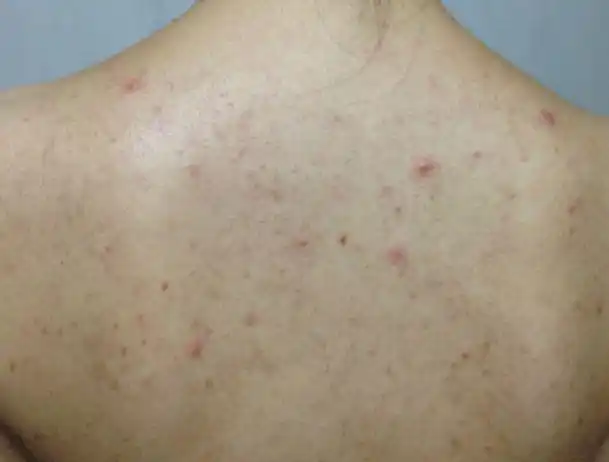 后背长了5年痘痘,原来因为"螨虫上身",你中招了吗?