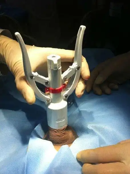 包皮手术现在该这么做