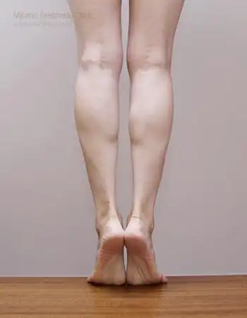 需是 有经验的医师操作,藉由小腿美型治疗,小腿肌肉治疗或两者合并