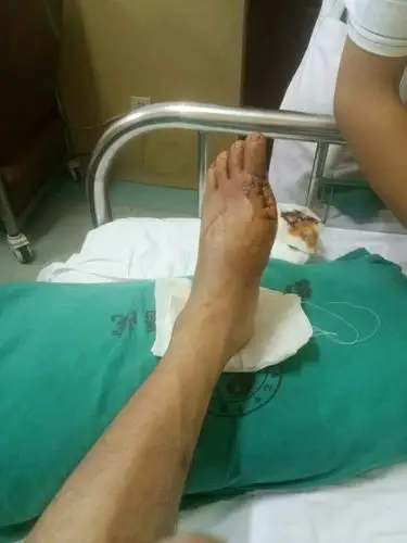 左脚大母子切掉评几级残