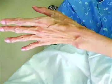 近日,记者从青岛阜外医院获悉,李女士是一位马凡氏综合征患者,因主