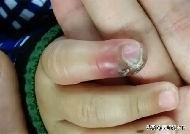 从小"咬指甲"的孩子,长大后会怎样?医生直言:逃不过3种结局