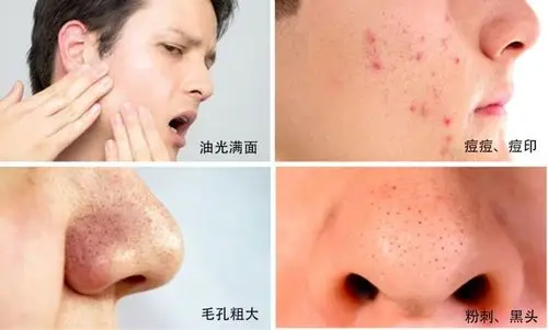 油脂得不到控制,肌肤问题就会反反复复