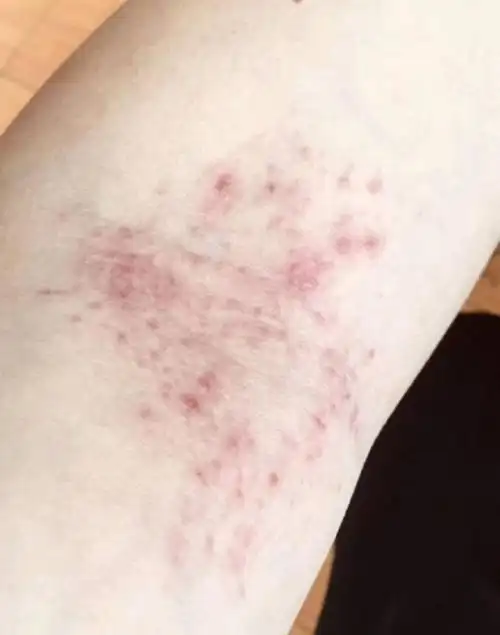 经验分享,助你解决湿疹困扰