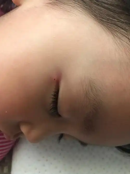 宝宝右边眼角发红已经两天有一个小疙瘩之前有白头她自己