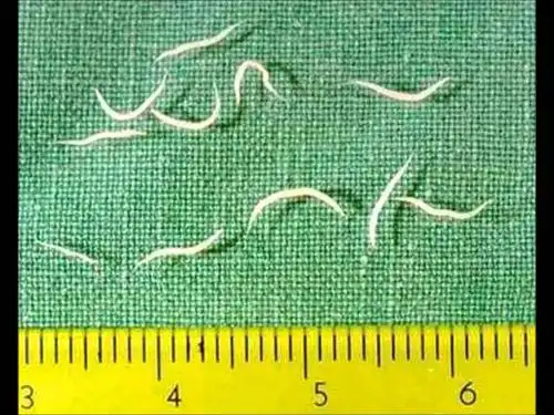 还需要特别注意,有无寄生虫感染,比如说 蛲虫病.