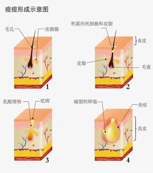 痘痘频发跟牛奶有关?