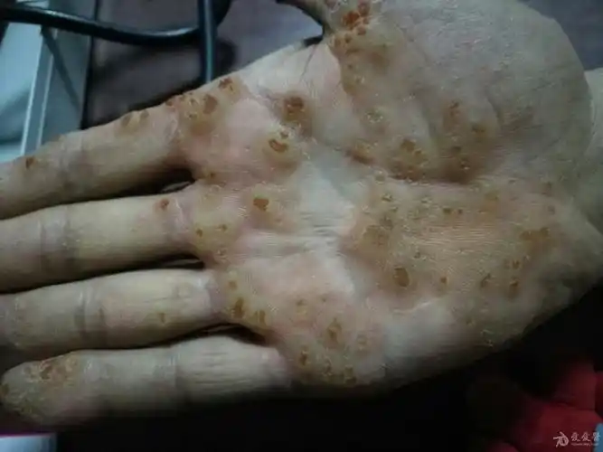 有奖猜图,积分大派送——202点状角化病