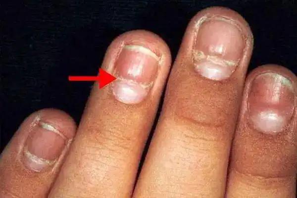 4岁女童指甲癌变医生警告这5种指甲症状预示健康大问题
