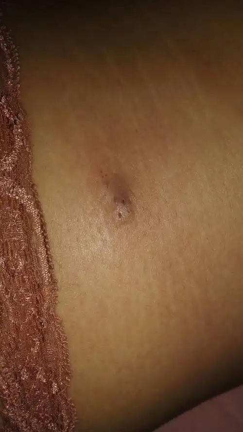 火疖子各时期图片