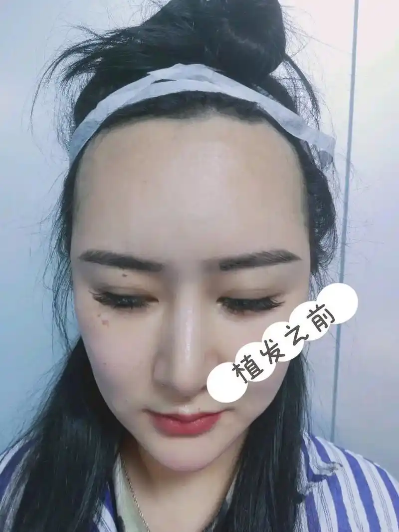 发际线直发完美解决! 直发前,额头很大 - 抖音