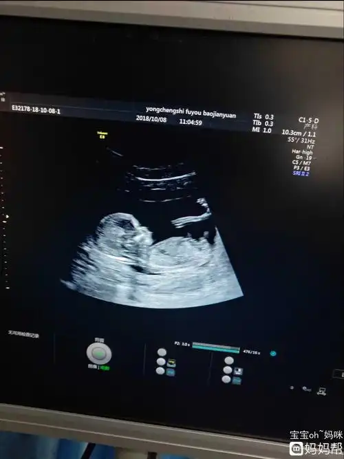 坦然!nt检查值看男女的方法介绍"卓越成绩"-第1张图片-西卡博客